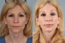 before and after facelift and neck lift female patient front view case 5852
