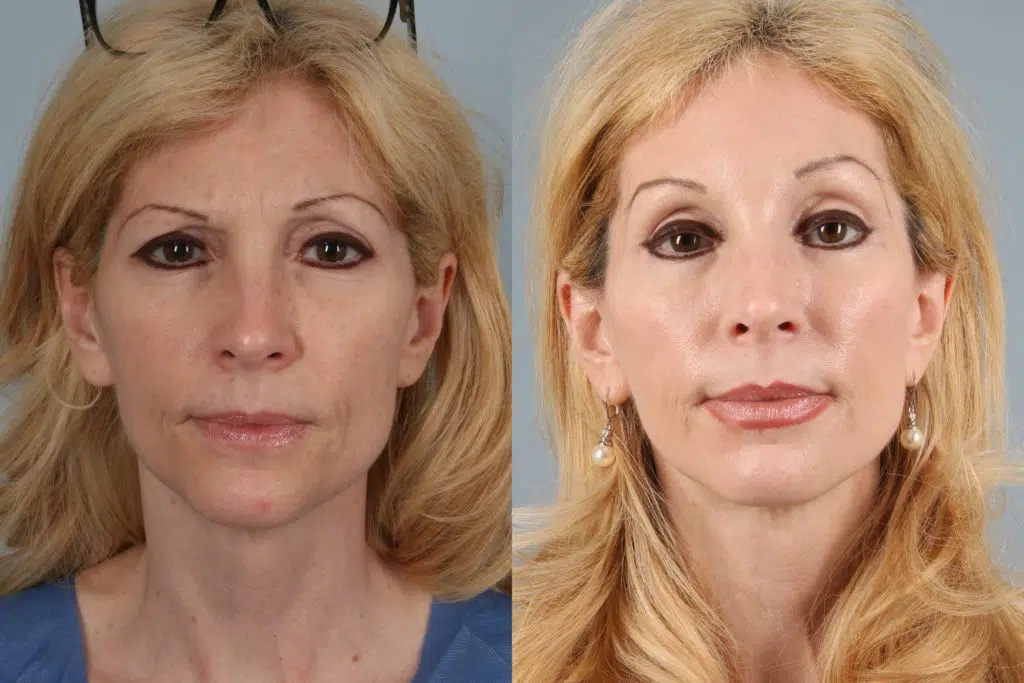 before and after facelift and neck lift female patient front view case 5852