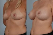 before and after breast augmentation left diagonal front view case 5690