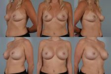 before and after breast augmentation female patient multiple angle view case 5690