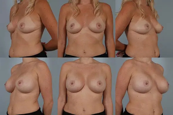 before and after breast augmentation female patient multiple angle view case 5690