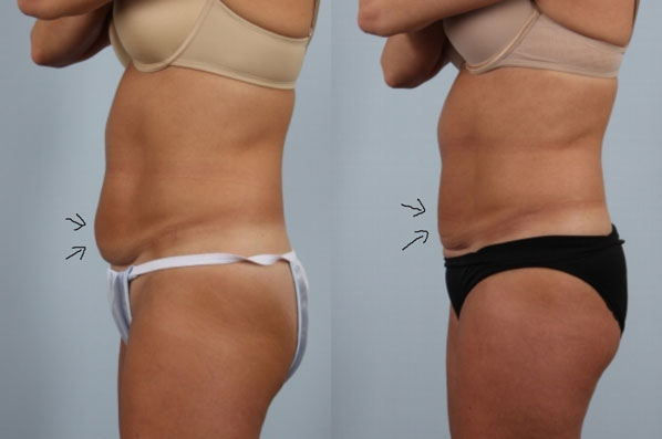 before and after coolsculpting female patient left side view