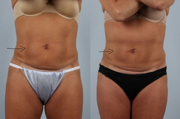 before and after coolsculpting female patient front view