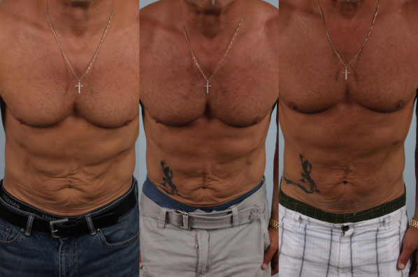 before and after coolsculpting male patient front view