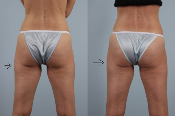 before and after coolsculpting female patient back view