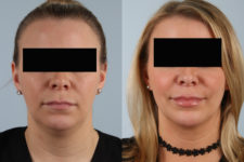before and after facelift SMAS composite (deep plane) female patient front view case 5378