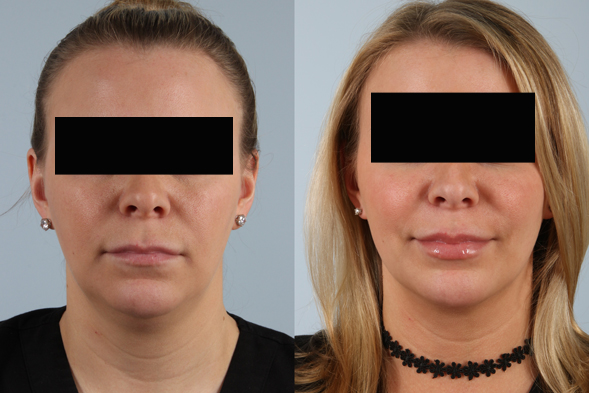 before and after facelift SMAS composite (deep plane) female patient front view case 5378