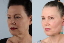 before and after facelift SMAS composite (deep plane) female patient left diagonal view case 5383