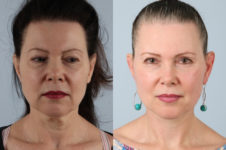 before and after facelift SMAS composite (deep plane) female patient front view case 5383