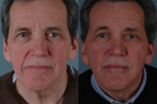 before and after facelift SMAS composite (deep plane) male patient front view case 5391