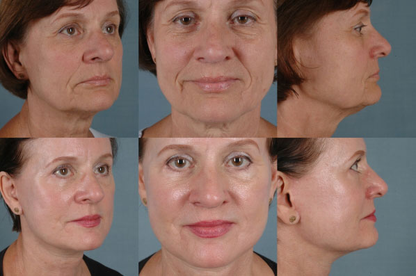 before and after facelift SMAS composite (deep plane) female patient multiple angle view case 5399