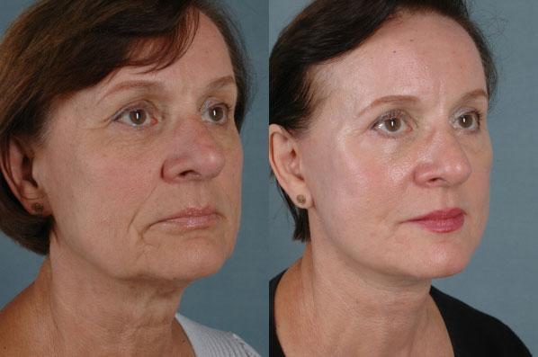 before and after facelift SMAS composite (deep plane) female patient right diagonal view case 5399