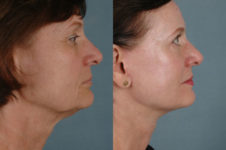 before and after facelift SMAS composite (deep plane) female patient right side view case 5399