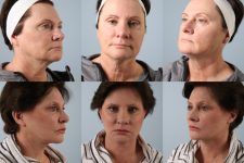 before and after facelift SMAS composite (deep plane) female patient multiple angle view case 5413
