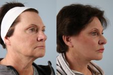 before and after facelift SMAS composite (deep plane) female patient right side view case 5413