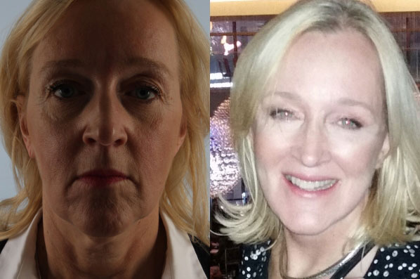 before and after facelift SMAS composite (deep plane) female patient front view case 5441