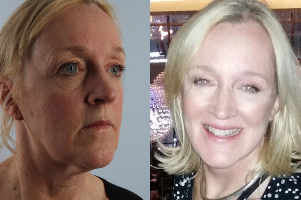 before and after facelift SMAS composite (deep plane) female patient front view case 5441