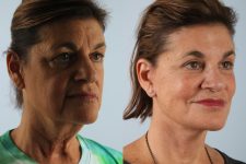 before and after facelift SMAS composite (deep plane) female patient right diagonal view case 5449