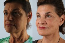 before and after facelift SMAS composite (deep plane) female patient left diagonal view case 5449