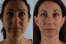 before and after facelift SMAS composite (deep plane) female patient front view case 5454