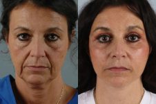before and after facelift SMAS composite (deep plane) female patient front view case 5458