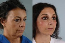 before and after facelift SMAS composite (deep plane) female patient right diagonal view case 5458