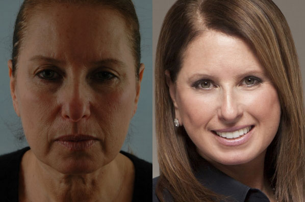 before and after facelift SMAS composite (deep plane) female patient front view case 5467