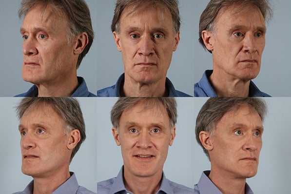 before and after facelift SMAS composite (deep plane) male patient multiple angle view case 5469