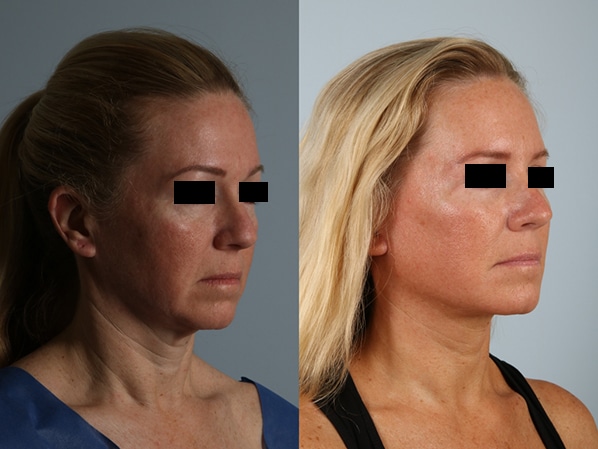 before and after facelift SMAS composite (deep plane) female patient right diagonal view case 5479