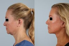 before and after facelift SMAS composite (deep plane) female patient left side view case 5479
