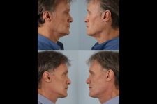 before and after photo facelift and neck lift male patient multiple view case 5469