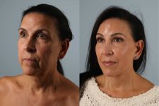 before and after photo facelift and neck lift female patient left diagonal view case 5518