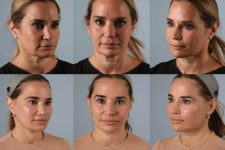 before and after photo facelift and neck lift female patient multiple views case 5512