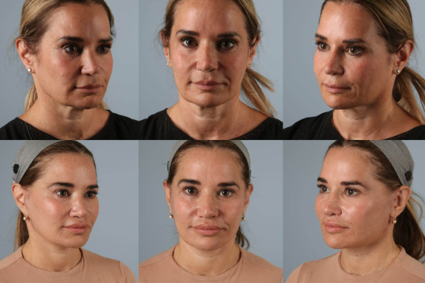 before and after photo facelift and neck lift female patient multiple views case 5512