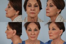 before and after photo facelift and neck lift female patient multiple views case 5489
