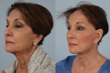 before and after photo facelift and neck lift female patient left diagonal front view case 5489