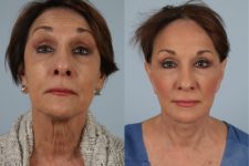 before and after photo facelift and neck lift female patient front view case 5489