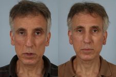 before and after facelift SMAS composite, neck lift, cervicoplasty, platysmaplasty male patient front view case 5474