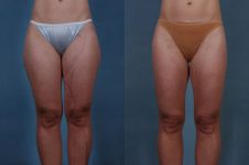 before and after liposuction female patient front view case 4701