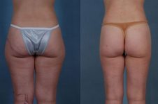 before and after liposuction female patient back view case 4701