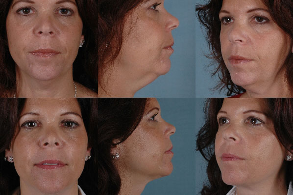 before and after liposuction female patient multiple angle view case 4705