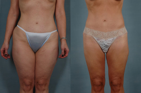 before and after liposuction female patient front view case 4707