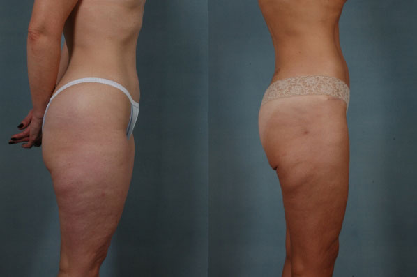 before and after liposuction female patient right side view case 4707