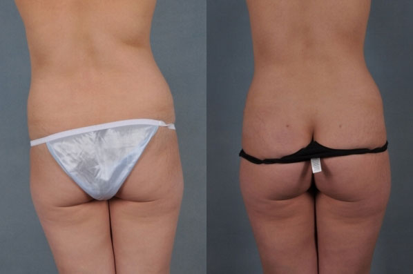 before and after liposuction female patient back view case 4711
