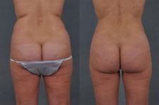 before and after liposuction female patient back view case 4715