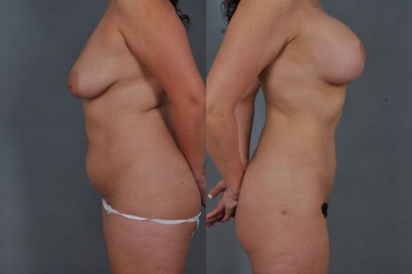 before and after liposuction female patient left and right side view case 4715