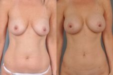 before and after liposuction female patient front view case 4725