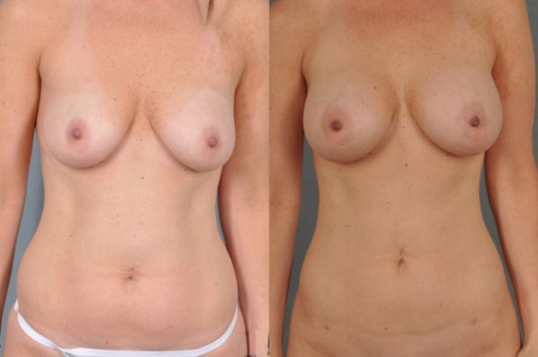 before and after liposuction female patient front view case 4725