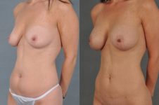 before and after liposuction female patient left diagonal view case 4725