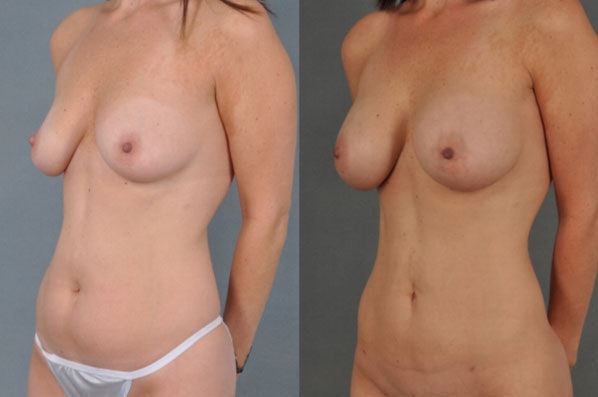 before and after liposuction female patient left diagonal view case 4725
